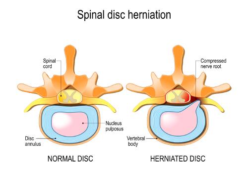 Spinal Disc Herniation Chiropractor Gresham OR Spinal Disc Herniation Chiropractor Gresham OR